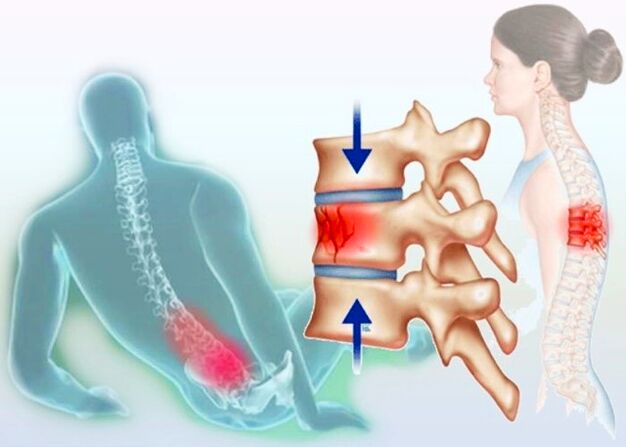 Même une blessure normale peut déclencher le développement de l'ostéochondrose
